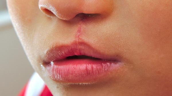 为什么会有兔唇 兔唇的两大形成原因需清除