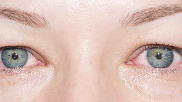 病毒性结膜炎会流眼泪吗 病毒性结膜炎眼睛有四个不适