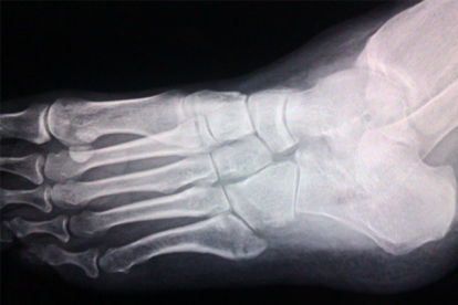 脚骨折多久能走路 6个护理让骨折脚成功行走