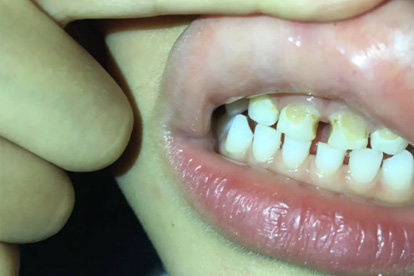 两牙相邻牙缝处蛀牙怎么办