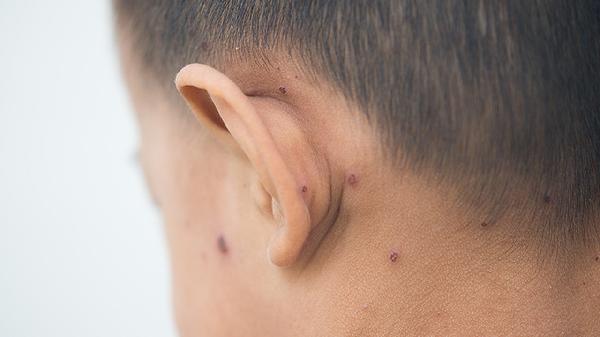 孩子上火耳朵疼的厉害怎么缓解