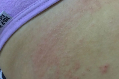 初生儿脸上长红疹是什么原因