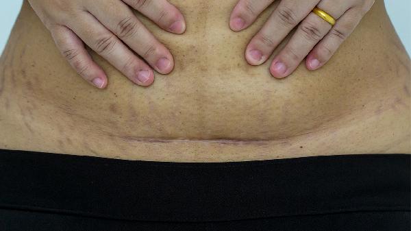 哺乳期可以去除剖腹产疤痕吗
