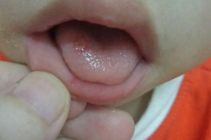 引起口腔溃疡的疾病有哪些