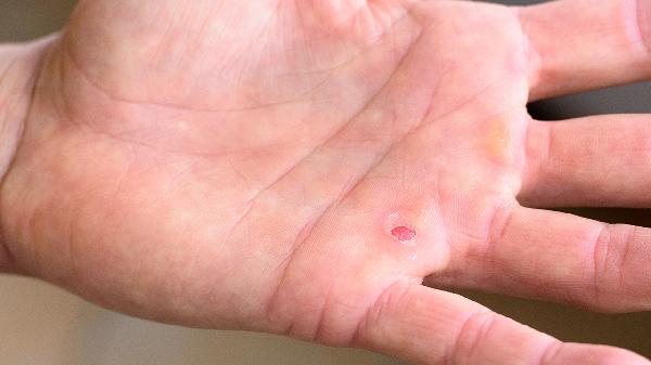 夏天手上的小水泡怎么处理