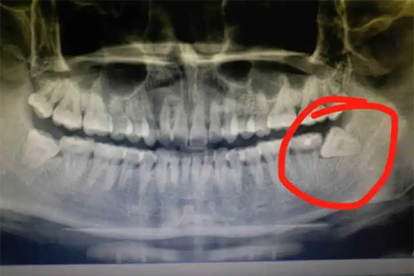 上排牙齿最里面的一颗是智齿吗