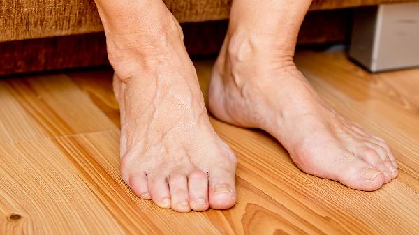 痛風(fēng)青睞白領(lǐng)男士的因素是什么