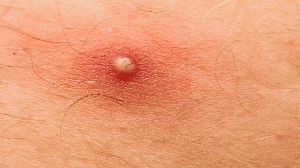 皮肤怎么补胶原蛋白有效健康