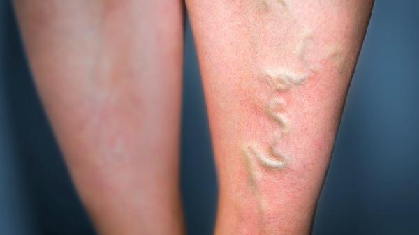 脚后跟运动后疼痛是什么原因