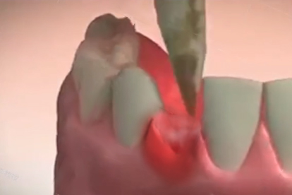 拔牙第三天比第二天疼怎么回事，怎么办