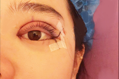 内双可不可以做开眼角手术 了解开眼角手术的适应症