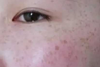 蝴蝶斑去除最有效的办法有哪些