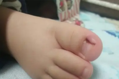 甲沟炎会传染吗  关于甲沟炎知识要正确认识