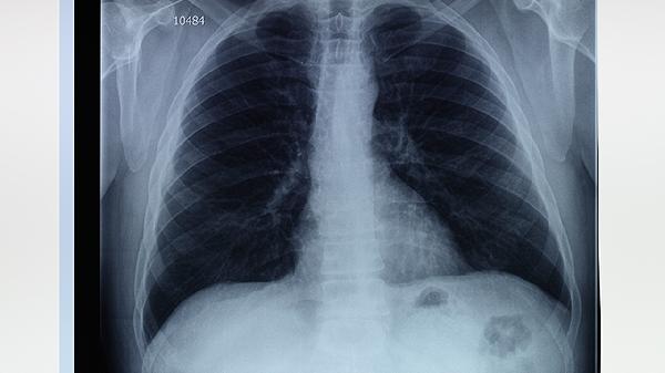 肺部切除后对今后生活有什么影响