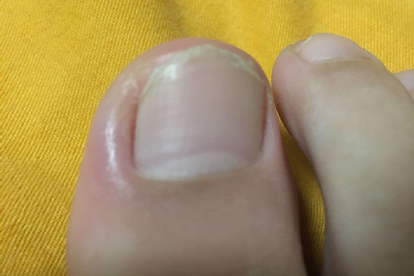 甲沟炎手术多久可以正常走路