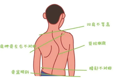 脊柱侧弯该怎么预防 预防脊柱侧弯的3方法盘点