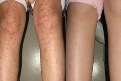 婴儿血小板减少性紫癜有什么症状
