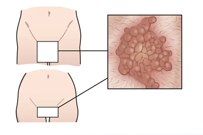 女性尖锐湿疣有什么症状和不适