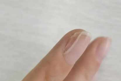 大拇指甲上有竖纹是什么原因