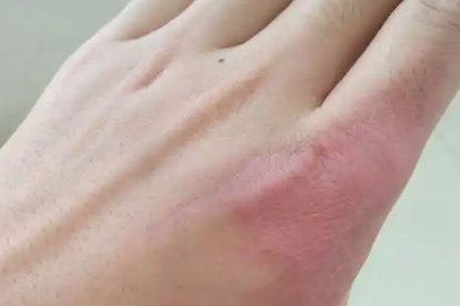 烫伤表皮没事但火辣辣疼怎么回事，怎么办