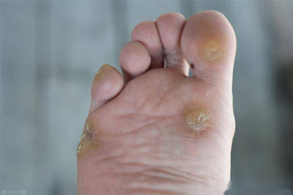 为什么手指上会长鸡眼 两个妙招快速去除手指鸡眼