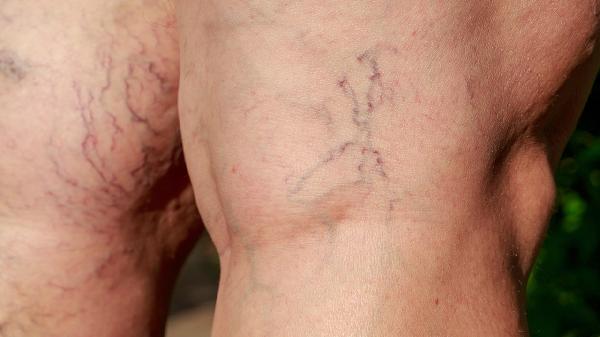 腿上静脉曲张是怎么引起的 腿上静脉曲张的几个病因分析