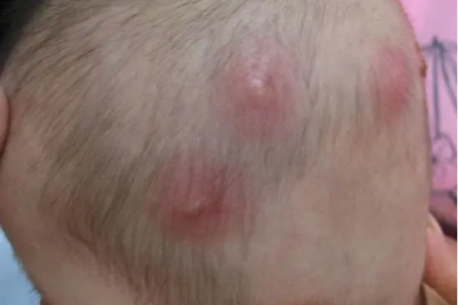 治疗毛囊炎需要遵循哪些原则