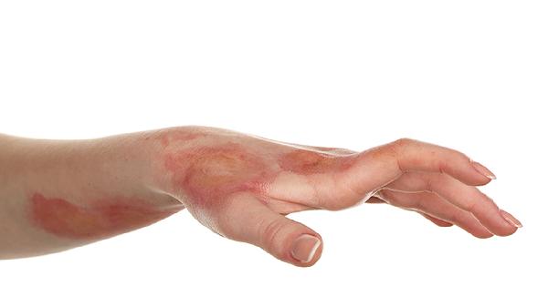 伤口两个月彻底愈合了吗 伤口愈合时间受四个因素影响