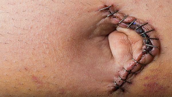 点阵激光真的能治疗各种疤痕吗