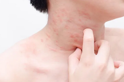 荨麻疹红色快速消除的方法