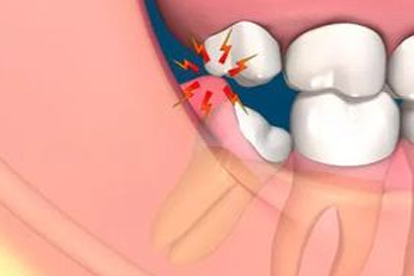 拔智齿后有哪些注意事项  拔智齿后4个事项要注意了