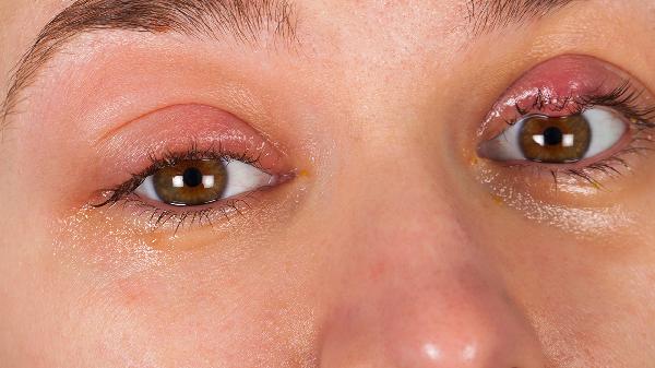 眼睛里突然有个红血点怎么回事