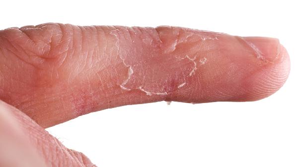 七个月宝宝手脱皮是怎么回事