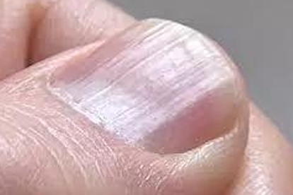 指甲长扁平苔藓的病因有哪些