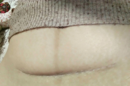 剖腹产孩子典型的特点有哪些