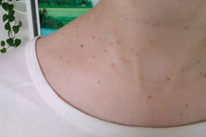 HPV51是男人传染的吗