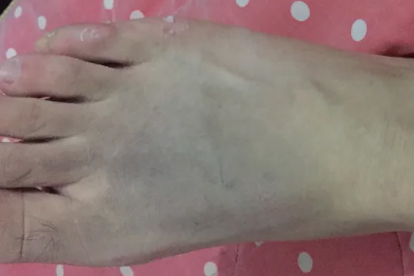 脚骨折后一睡觉就突然抽一下会影响愈合吗