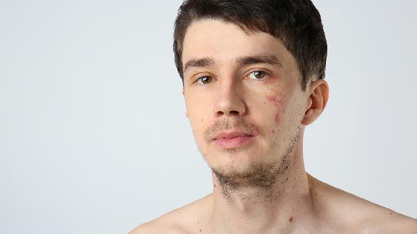 80度醋精能直接接触皮肤吗