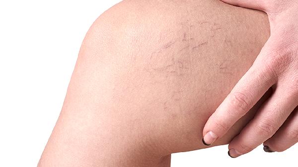 膝盖积液该怎么治疗 揭晓膝盖积液的几个疗法