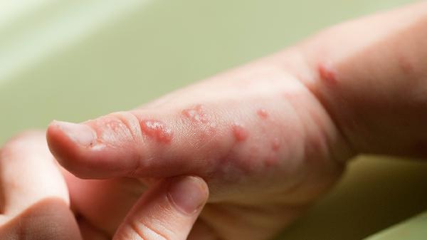 水疱型手足癣需要注意什么
