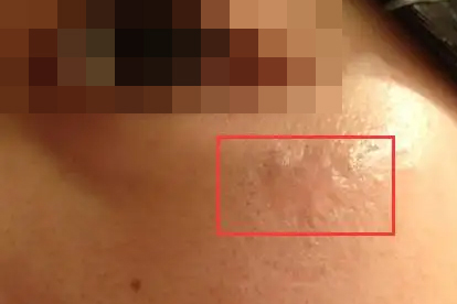 食管瘢痕性狭窄的病因是什么