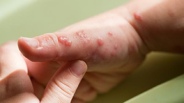 疱疹性结膜炎传染吗 疱疹性结膜炎的产生原因细说