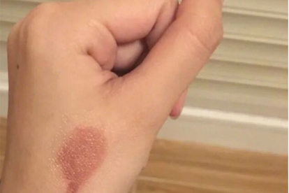烫伤脱皮掉了露出红肉怎么办