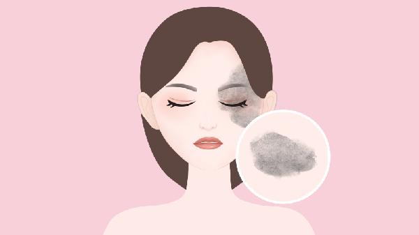 太田痣会不会遗传  带你了解太田痣这几个热点问题