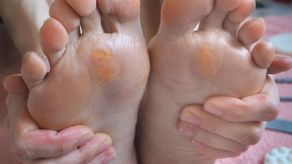 患上鸡眼有哪些常见的治疗方法