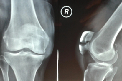 髌骨骨折后肌肉萎缩怎么回事