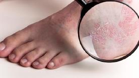 扁平疣不痛不痒，需要治疗吗？这4个方法可消除，帮你“消灭”它
