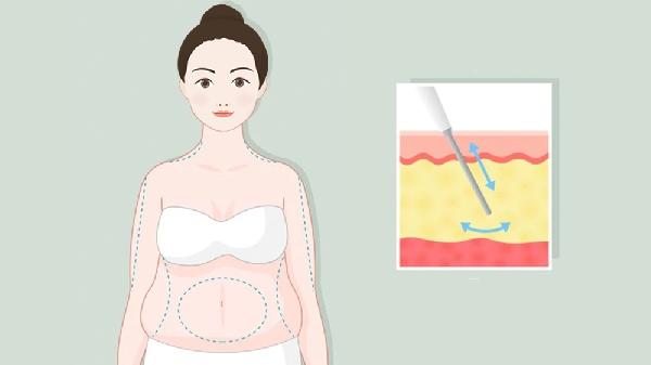 360°环形聚能吸脂减肥瘦身术有哪些好处