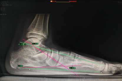 扁平足手术后能和正常人一样吗