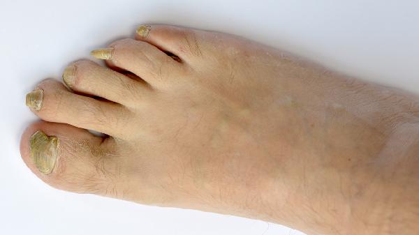 食指指甲异常不知道怎么回事